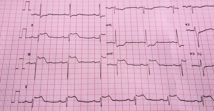 ECG - STEMI - tekenen van ST-elevatie en hartspierinfarct