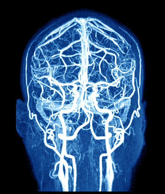 MRI van de hersenen en hersenvaten