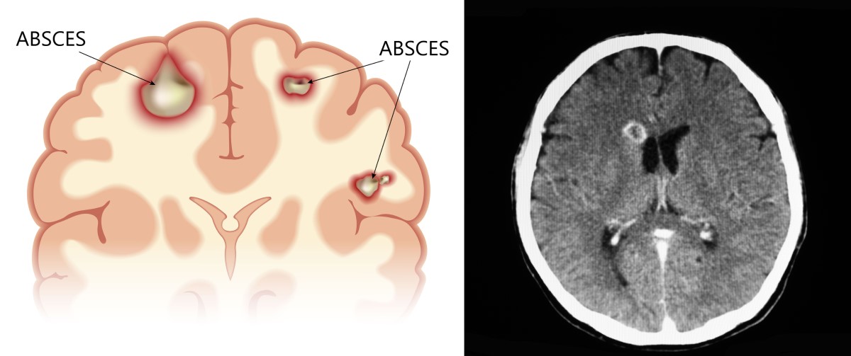 Anatomische beelden en CT-scans van een hersenabces