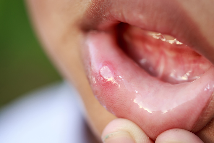 Aphta aan de binnenkant van de lippen van het kind