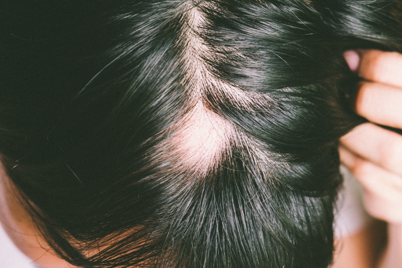 Alopecia, hoofd, zwart haar, aandoening van overmatig haarverlies