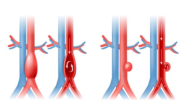 Aorta-aneurysma en bloedstroom