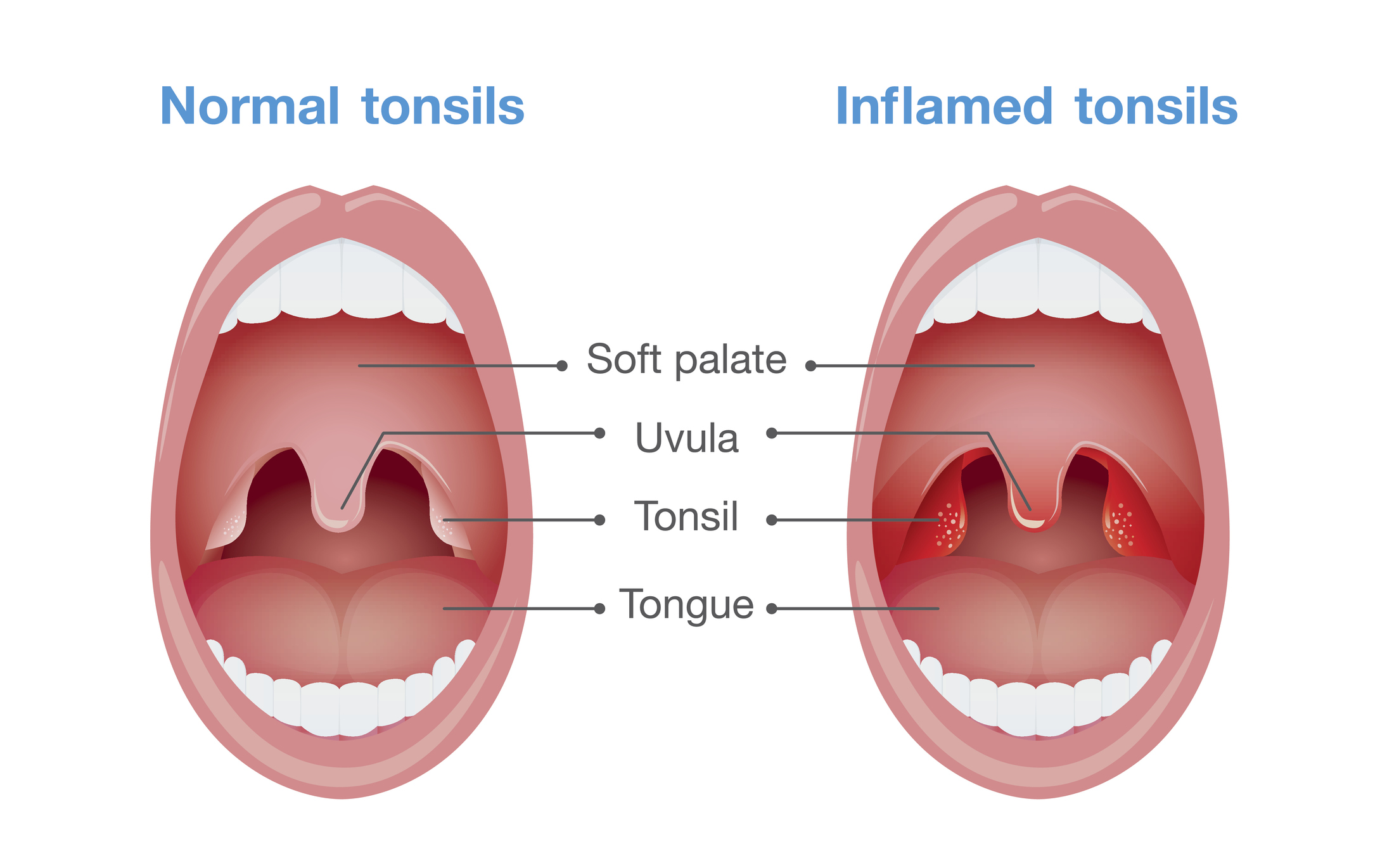 Angina - ontsteking van de amandelen