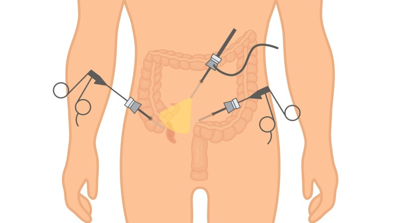 Modelweergave van laparoscopie bij appendicitis