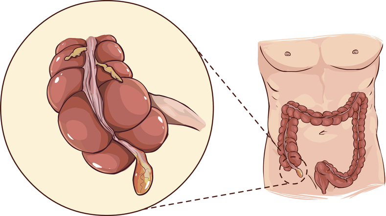 Appendix - anatomische weergave aan het begin van de dikke darm