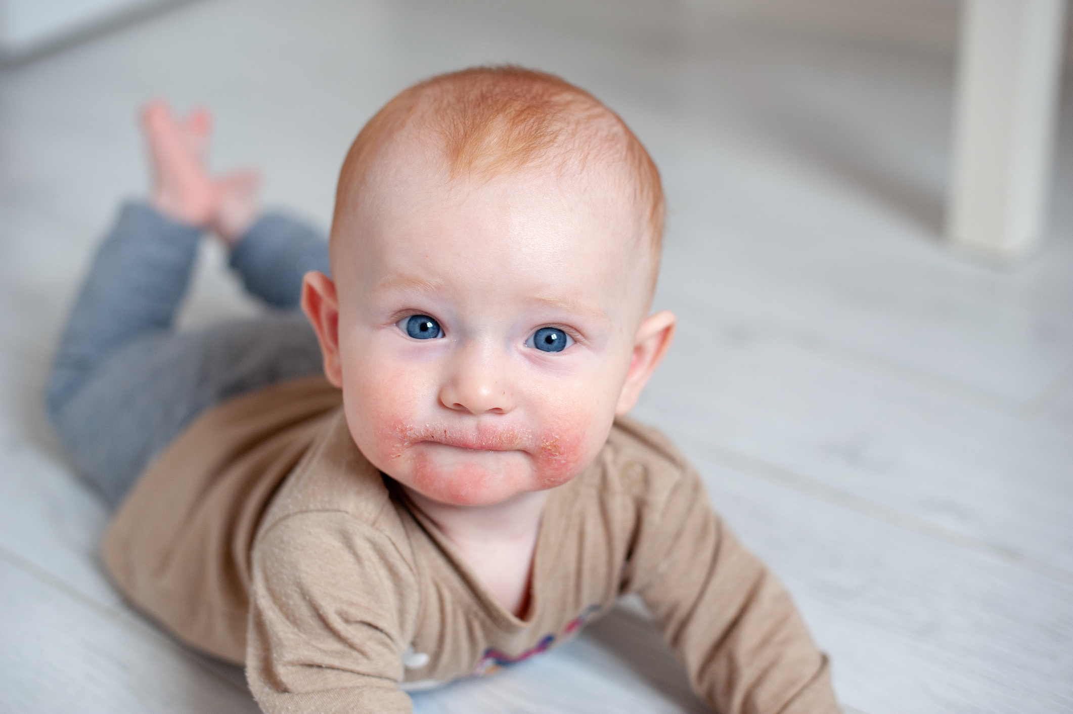 Atopische dermatitis in het gezicht van het kind