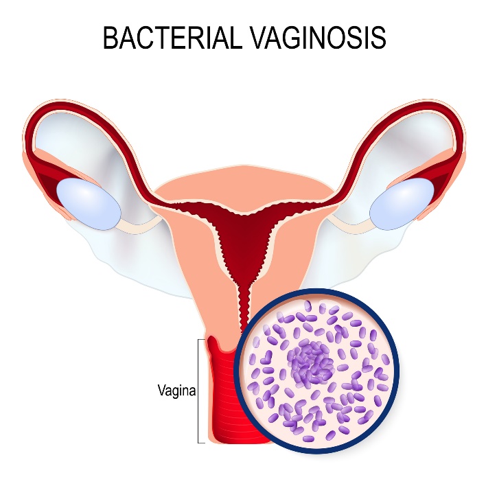 Bacteriële vaginose en Gardnerella vaginalis overgroei