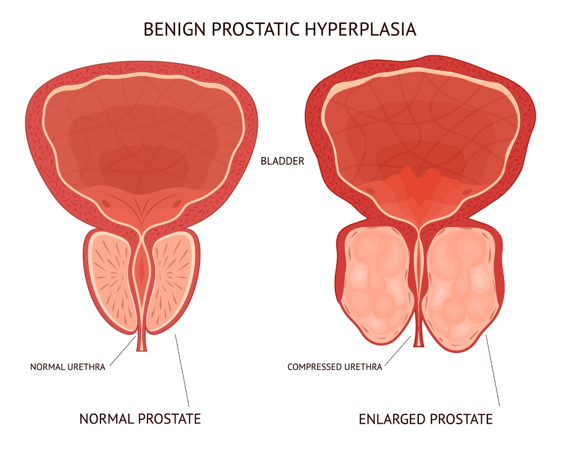 Goedaardige (benigne) prostaathyperplasie