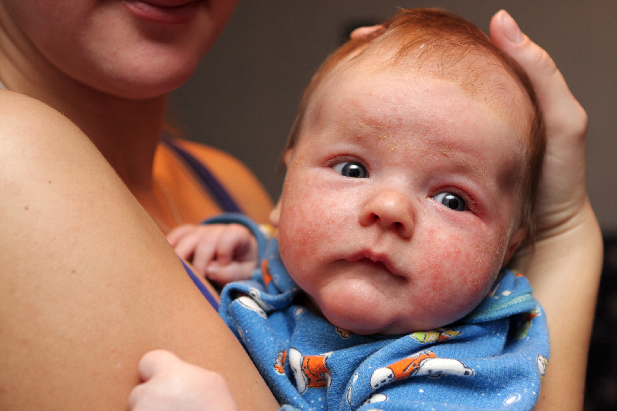 Dermatitis op het gezicht van een klein kind