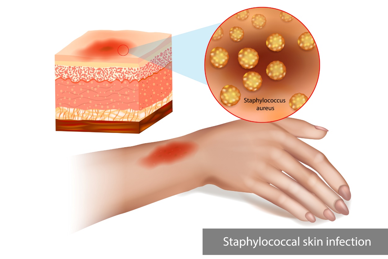 Staphylococcus huidinfectie