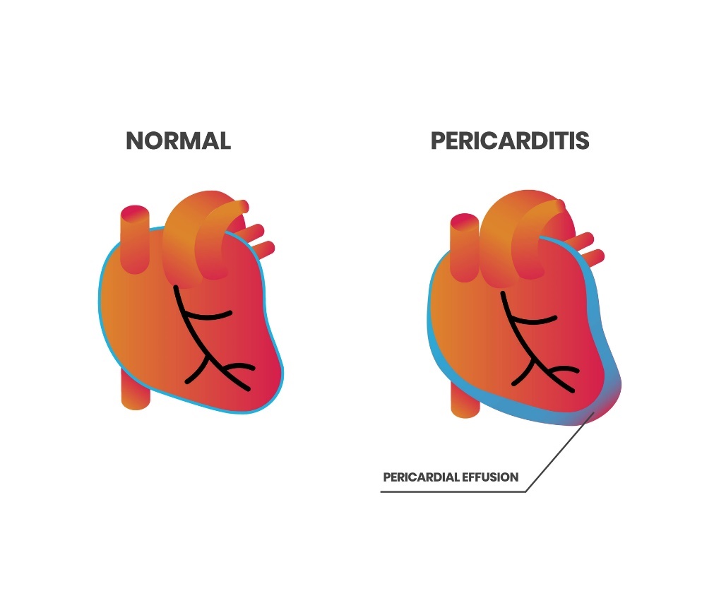 Hartfysiologie en pericarditis (pericardiale effusie)