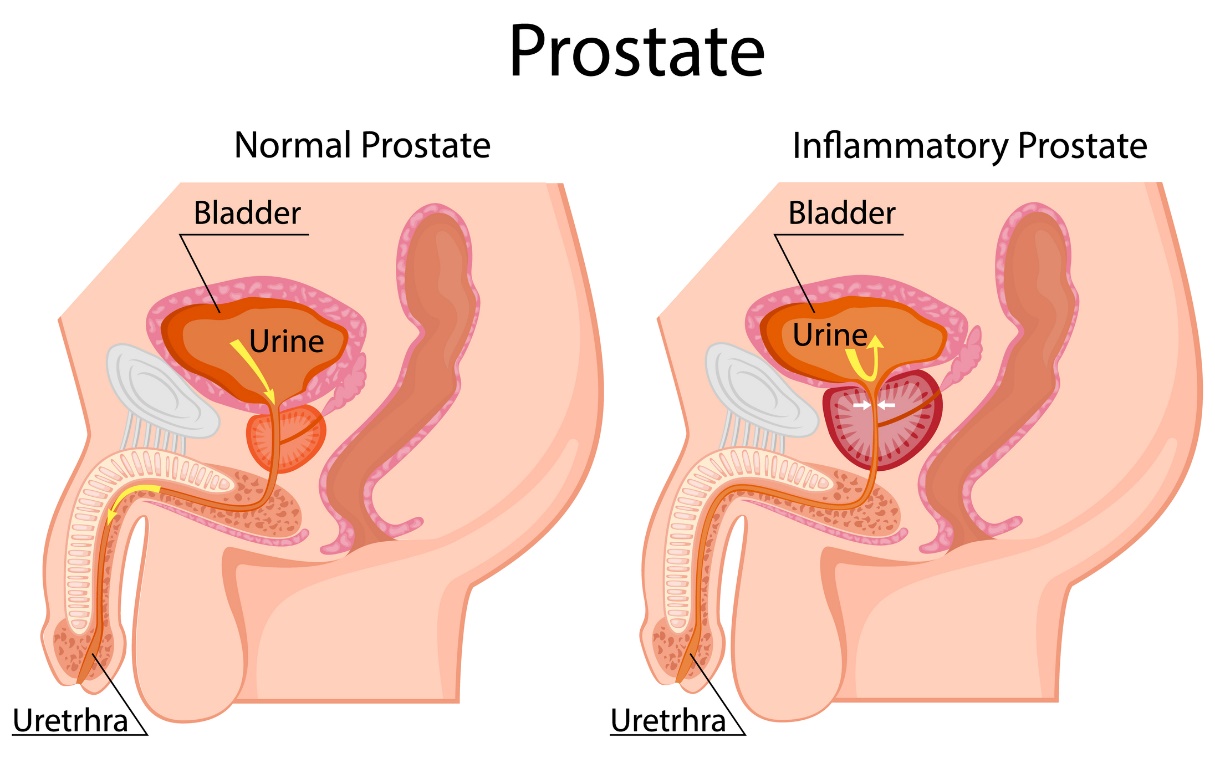 Links: fysiologische prostaat. Rechts: vergrote prostaat. Ligt onder de blaas. Blaas, urine, urinebuis.