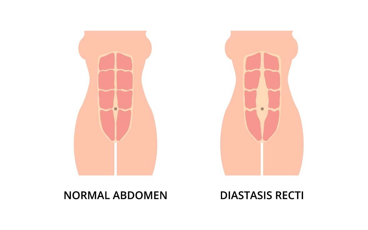 Fysiologische toestand van de buikspieren en diastase (afstand) van de linker en rechter rectus abdominisspieren vanaf de middellijn van de linea alba