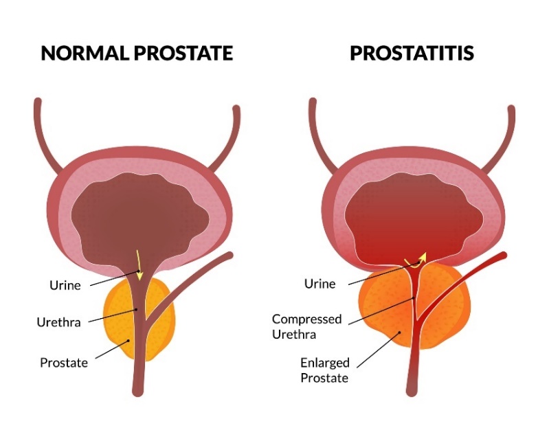 De fysiologische toestand van de prostaat en prostatitis