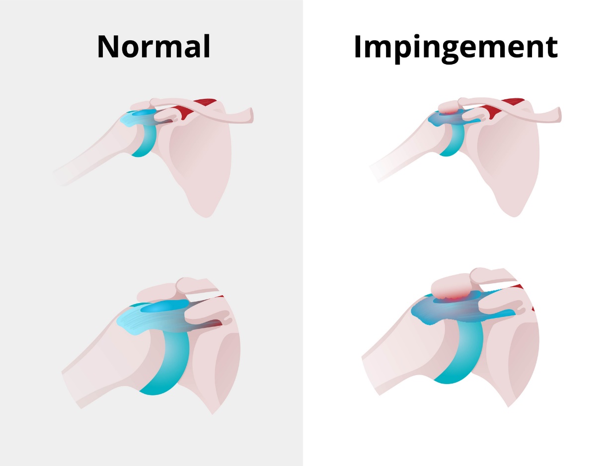 Fysiologische status van het schoudergewricht en impingement syndroom