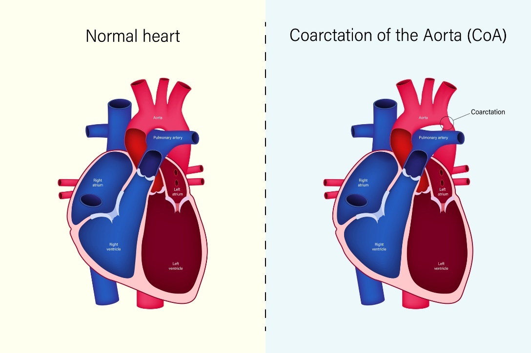 Fysiologische toestand van het hart en coarctatie van de aorta (CoA)