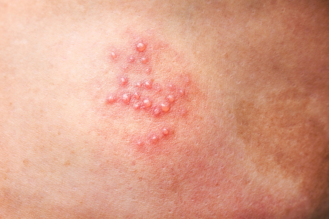 Herpes genitalis