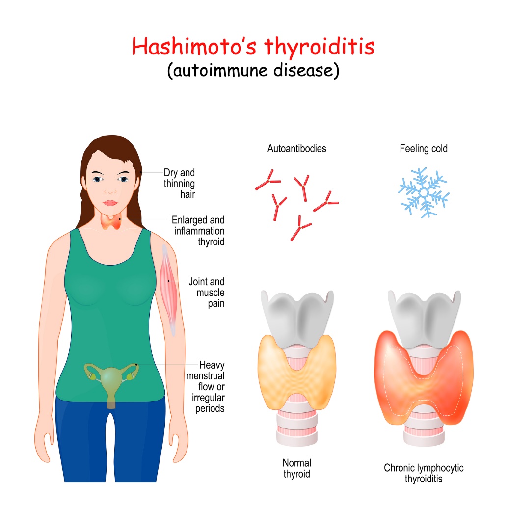 Hashimoto's thyroïditis en klinische symptomen