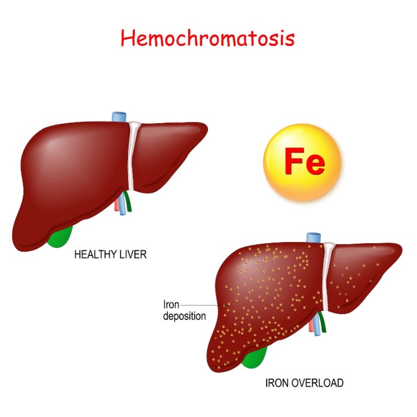 Hemochromatose: fysiologie en pathologie van de lever met overmatige ijzerafzetting (Fe)