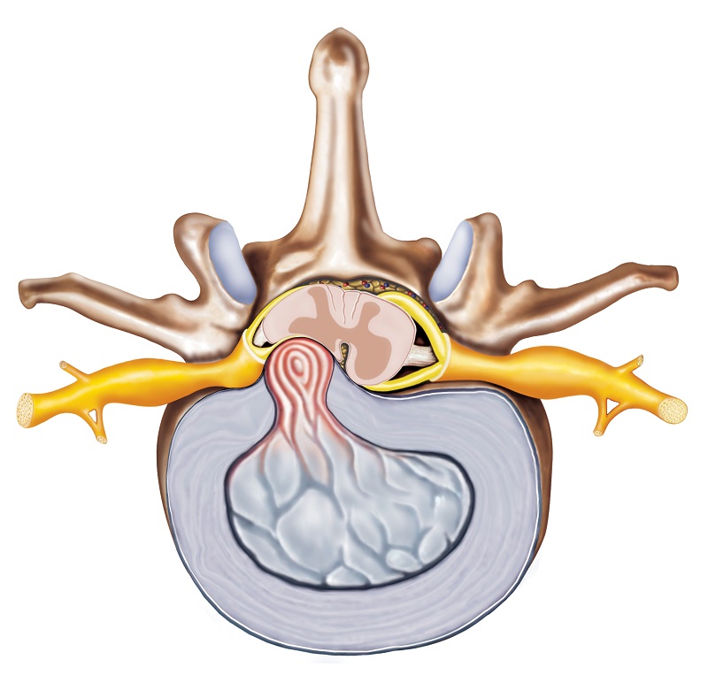 Hernia - anatomische weergave