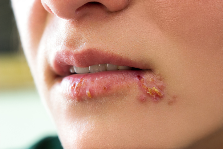 Herpes simplex op het gezicht - lippen en mondhoek