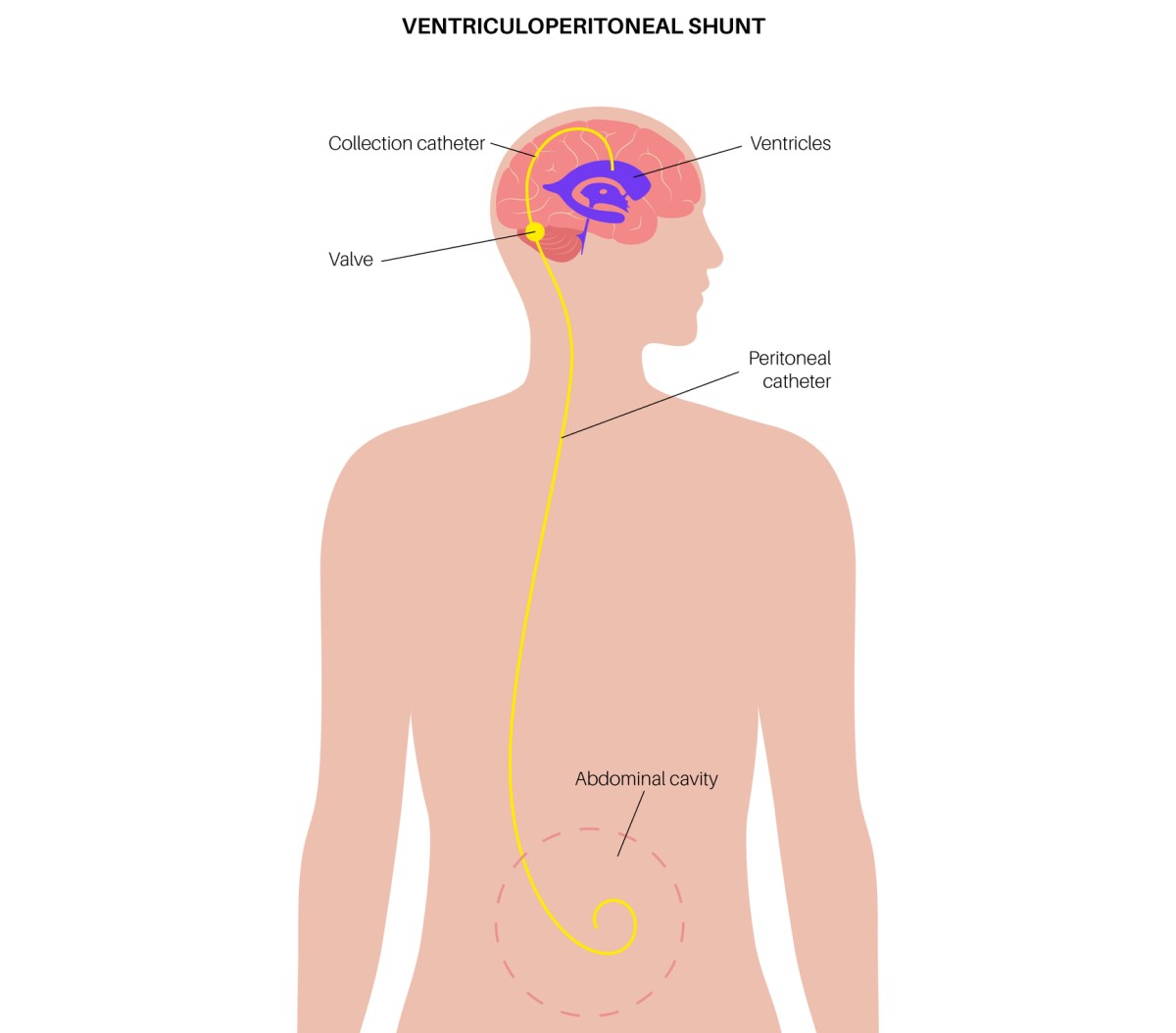 Illustratie van een ventriculo-abdominale shunt die overtollig vocht uit de hersenen afvoert naar de buikholte.