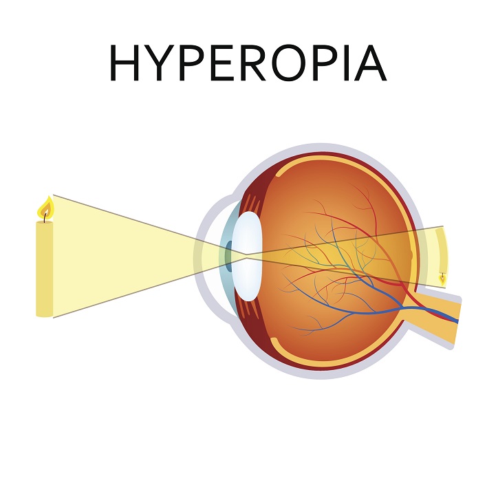 Hypermetropie