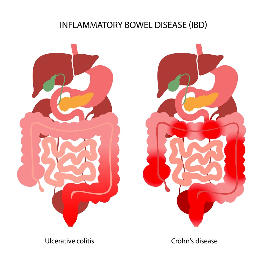 IBD: onderverdeeld in colitis ulcerosa en de ziekte van Crohn volgens de lokalisatie van de ontstekingsreactie.