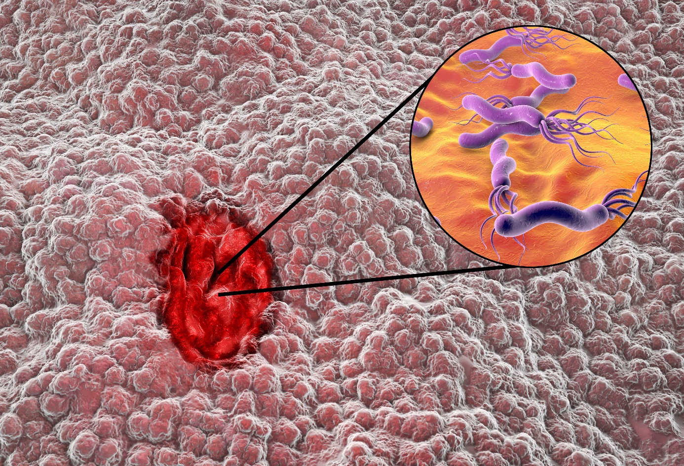 Helicobacter pylori infectie