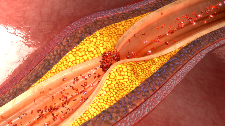 Angina pectoris en atherosclerose en atherosclerotische plaque in de kransslagader of het hartvat