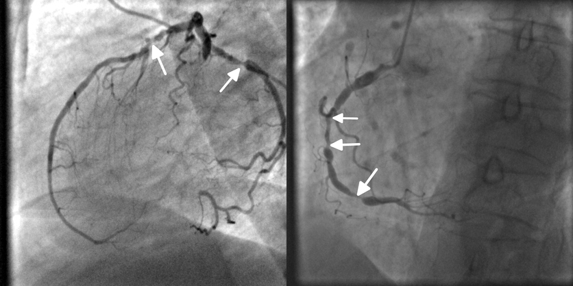 Coronarografie, angiografie, kransslagaderverstopping