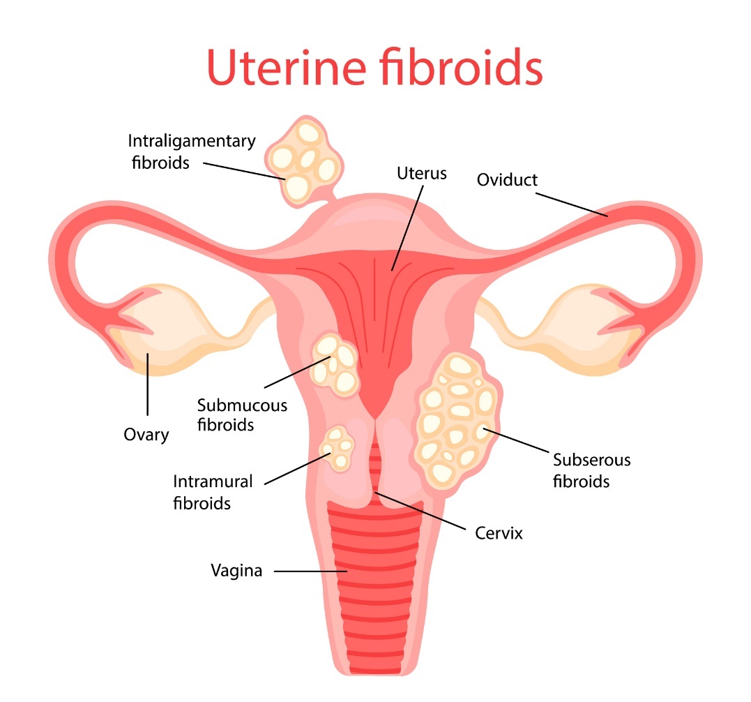 Baarmoederfibromen (uterusmyomen)