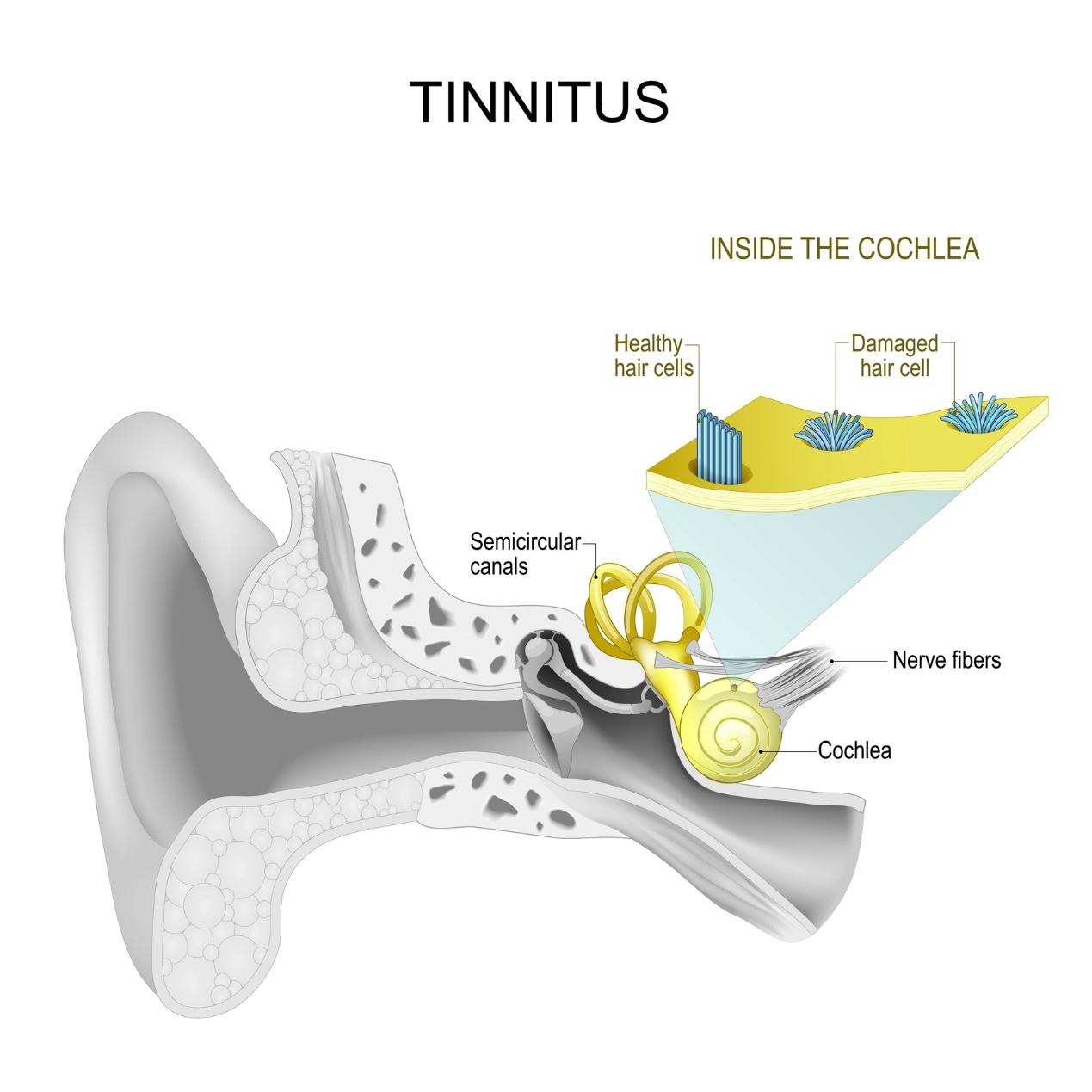 Binnenoor en tinnitus - gefluit en gebrom in het oor