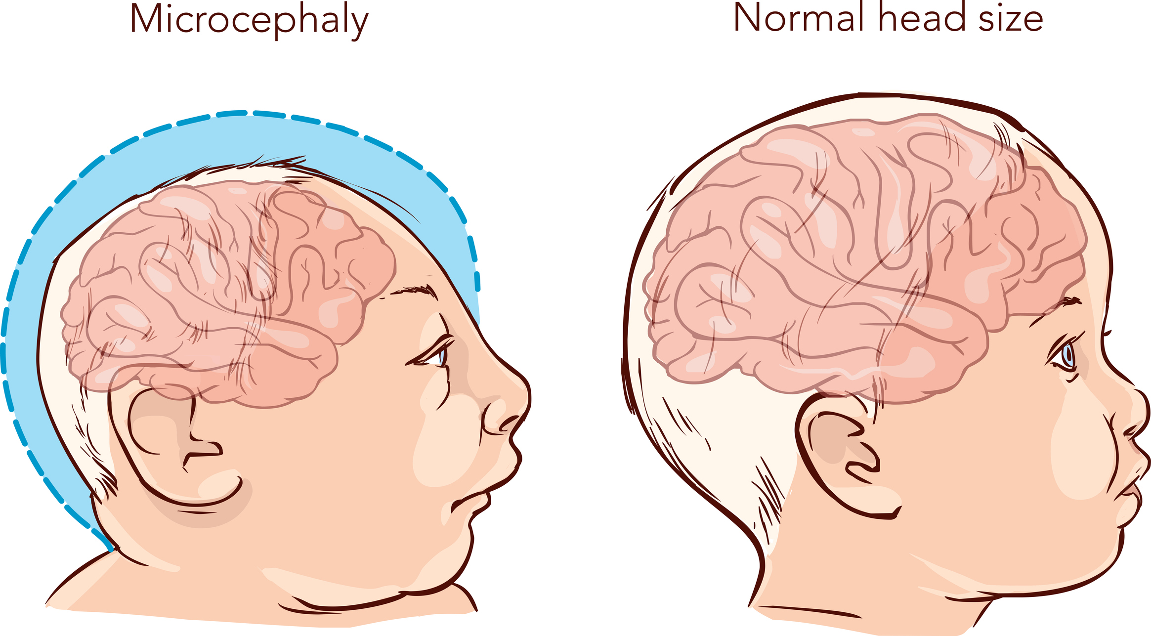 Microcefalie