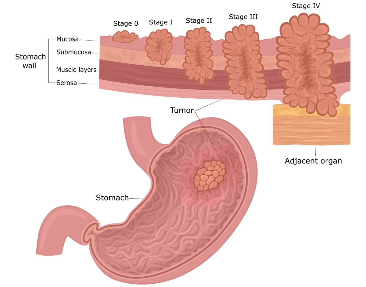 Maagkanker: de lagen van de maagwand (mucosa, submucosa, spier, serosa) en de stadia van tumorontwikkeling van de mucosa naar de omgeving en de organen.