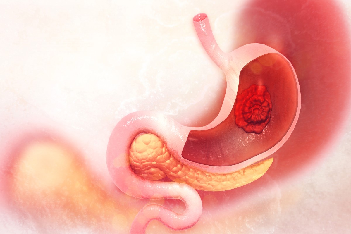 Visualisatie van een kwaadaardige tumor gelokaliseerd in de maag.