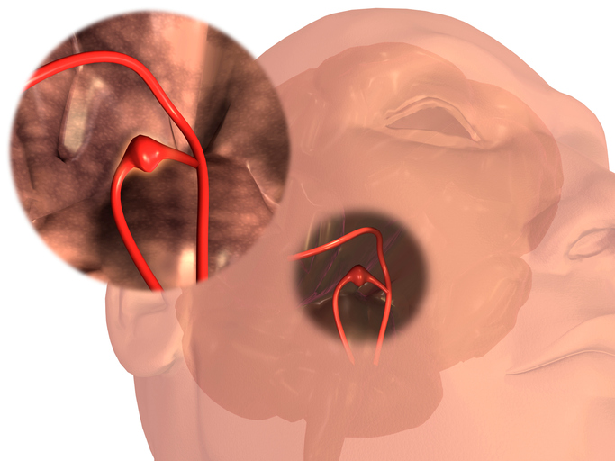 Aneurysma van een cerebraal bloedvat