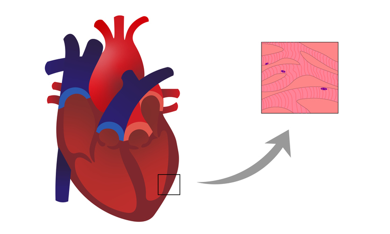 Myocarditis: een ontstekingsproces met infiltraat en degeneratie van cardiomyocyten in de wand van de hartspier.