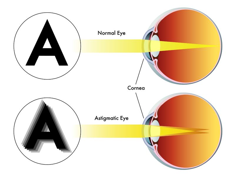 hoe een normaal oog een letter ziet in vergelijking met een astigmatisch oog