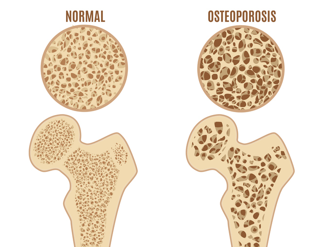 Osteoporose van het dijbeen