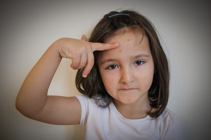 Varicella zoster-virus - meisje met zaadjes in het gezicht