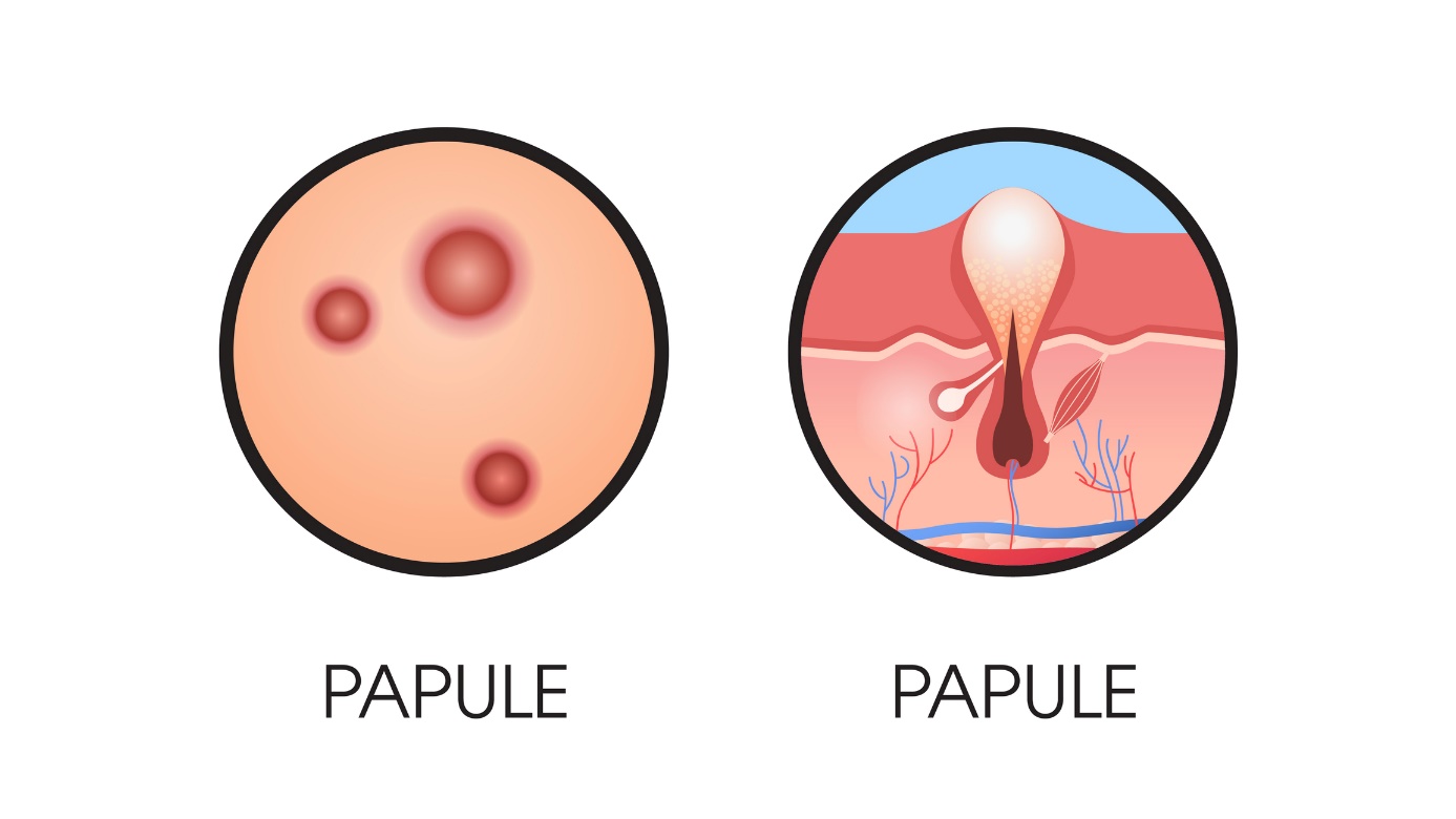 papule op de huid