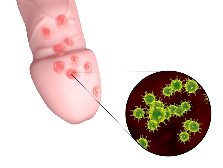 De vorming van kleine herpesblaasjes in het genitale gebied van het mannelijke orgaan.