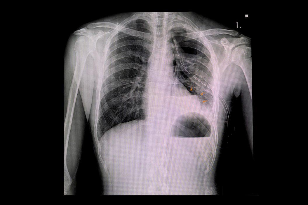 Röntgenfoto van pneumothorax van de linkerlong en luchtophoping in de borstholte (witte kleur)