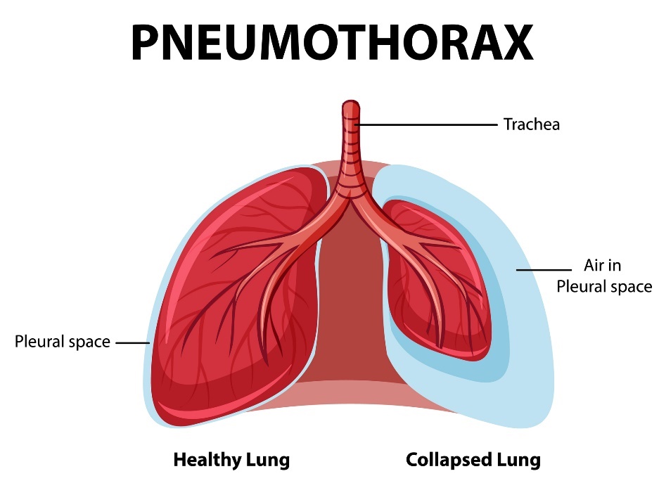 Pneumothorax: gezonde en ingeklapte longen