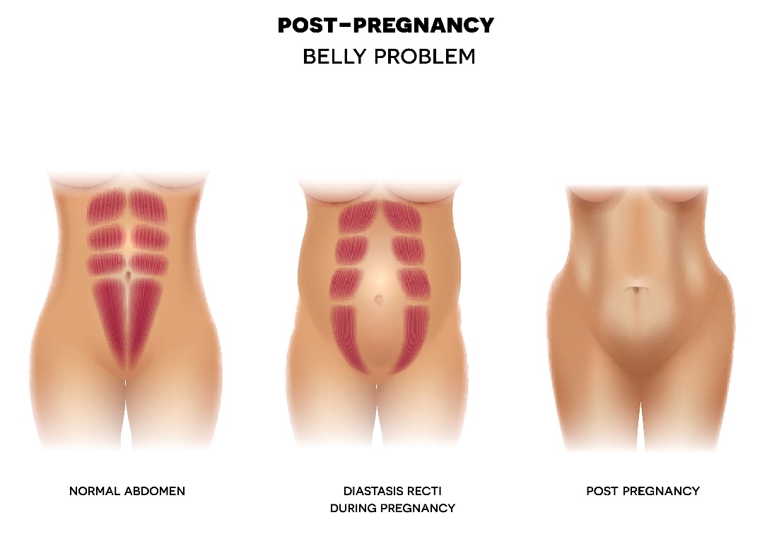 Postpartum diastase van de buikwand