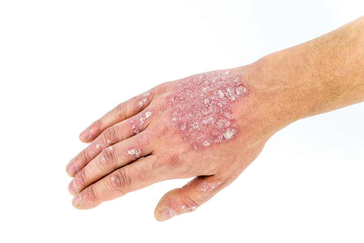 Psoriasis of psoriasis op de hand, dorsum van de hand