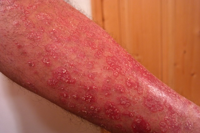 Psoriasis op de bovenste ledematen, op de onderarm