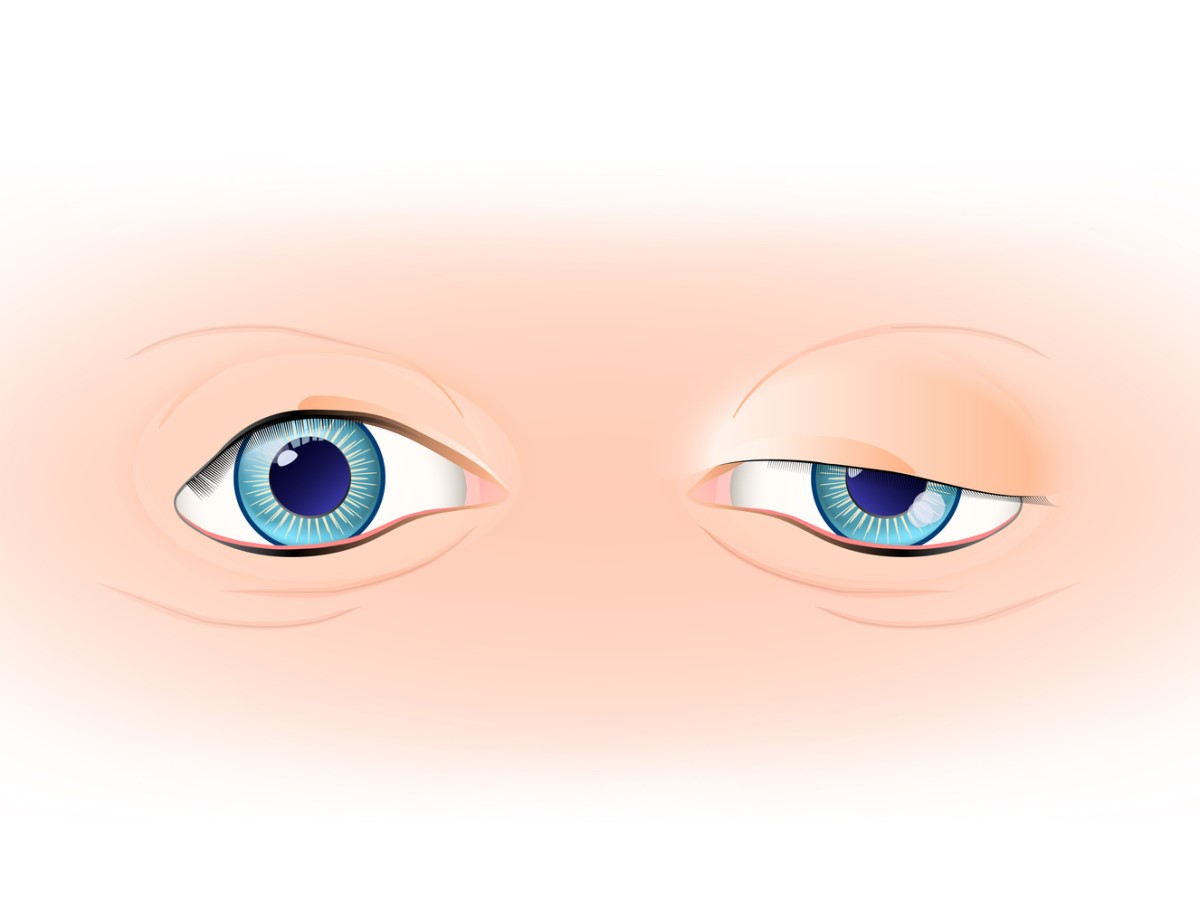 Ooglid ptosis, linker ooglid in normale conditie en rechter ooglid met droop - ptosis