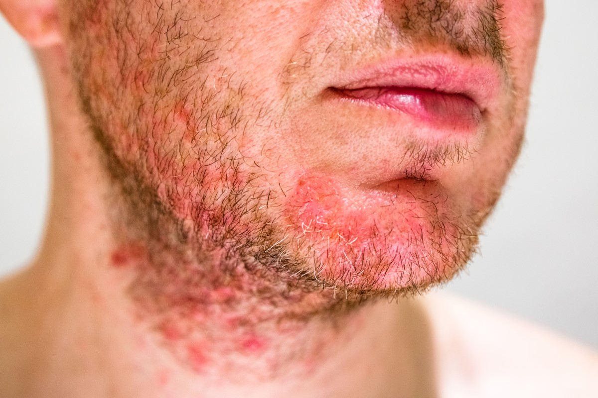 Man met seborroe op kin, rood gezicht met tekenen van dermatitis